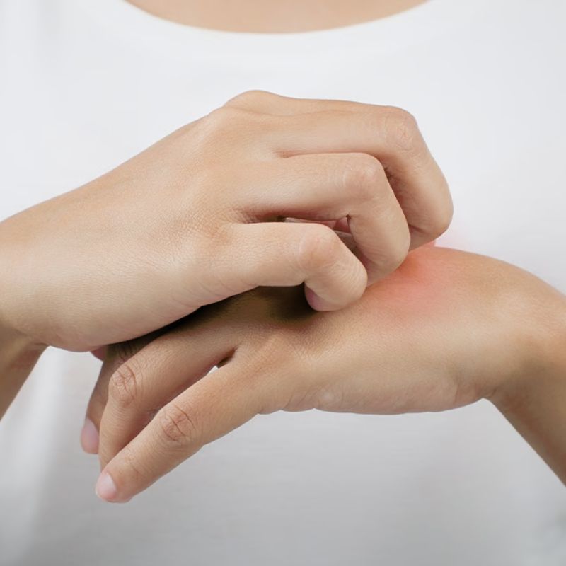 Cara mudah rawat eczema secara tradisional dan moden, terbukti berkesan!