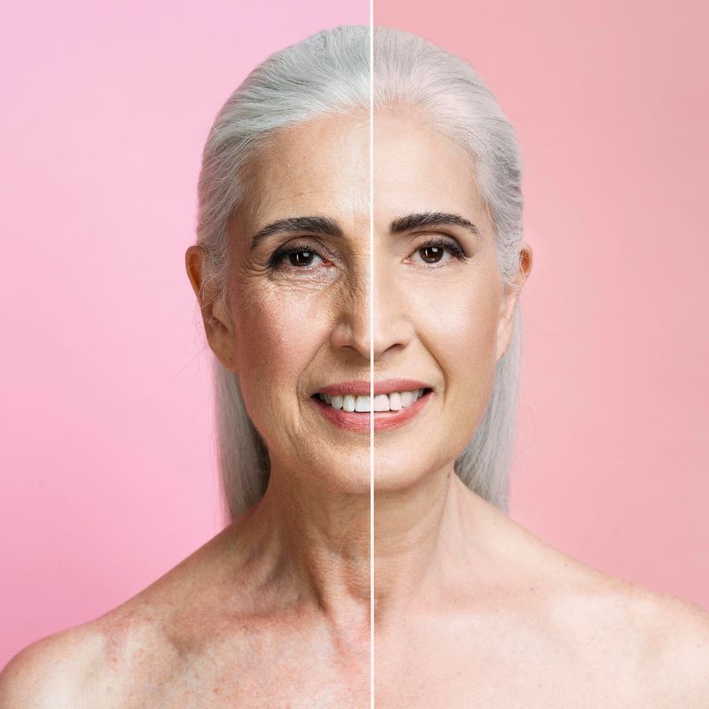 What to know before you get a face-lift