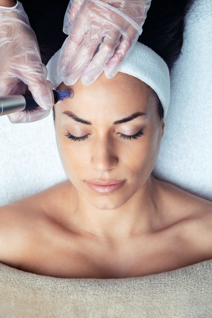 Is microneedling capable of bidding your acne scars a permanent adieu? Let’s find out!