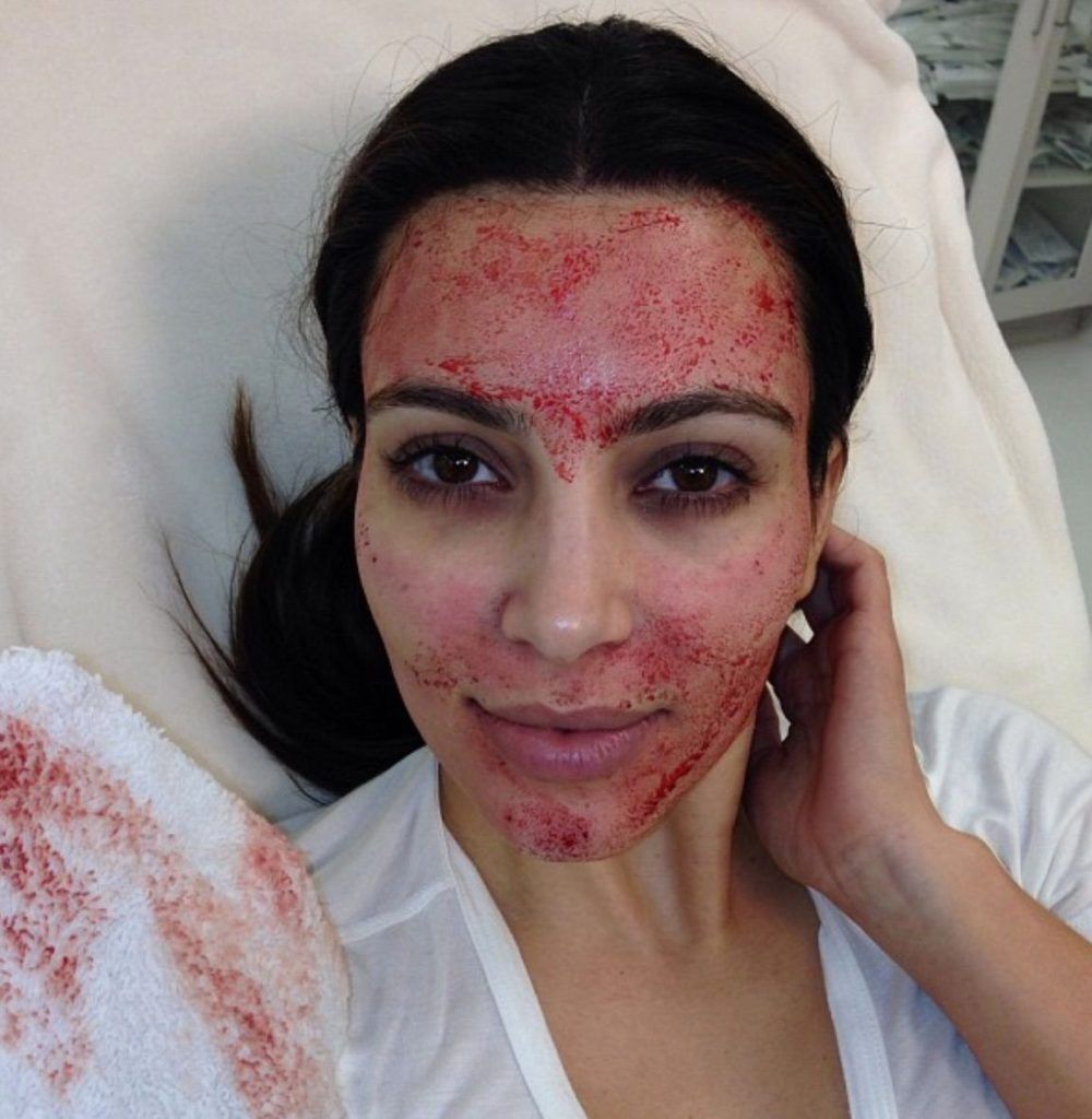 Are vampire facials the secret to younger-looking skin? Let’s find out