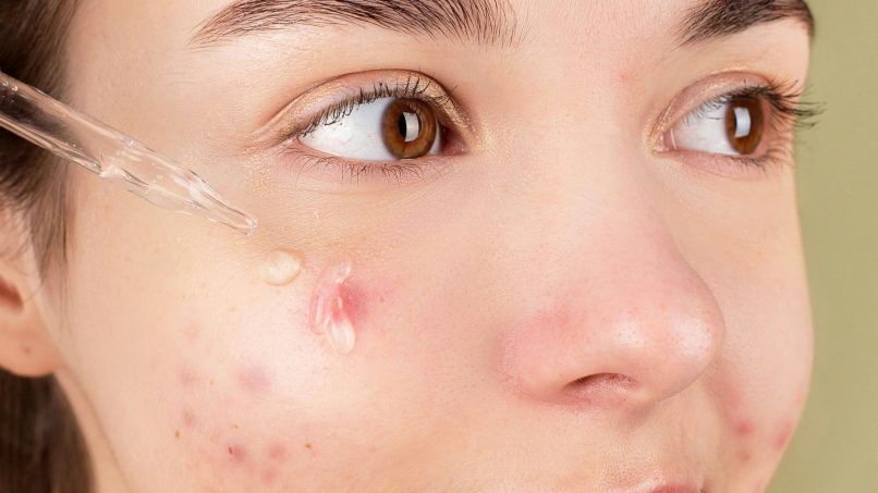 How to get rid of pimple marks
