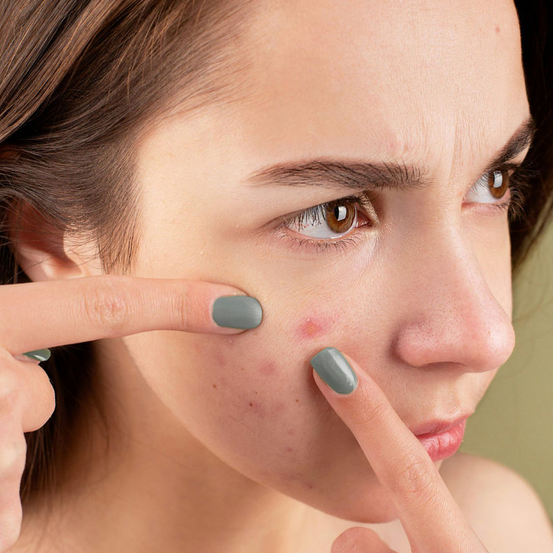 Blemish be gone: Four effective methods to get rid of pimple marks