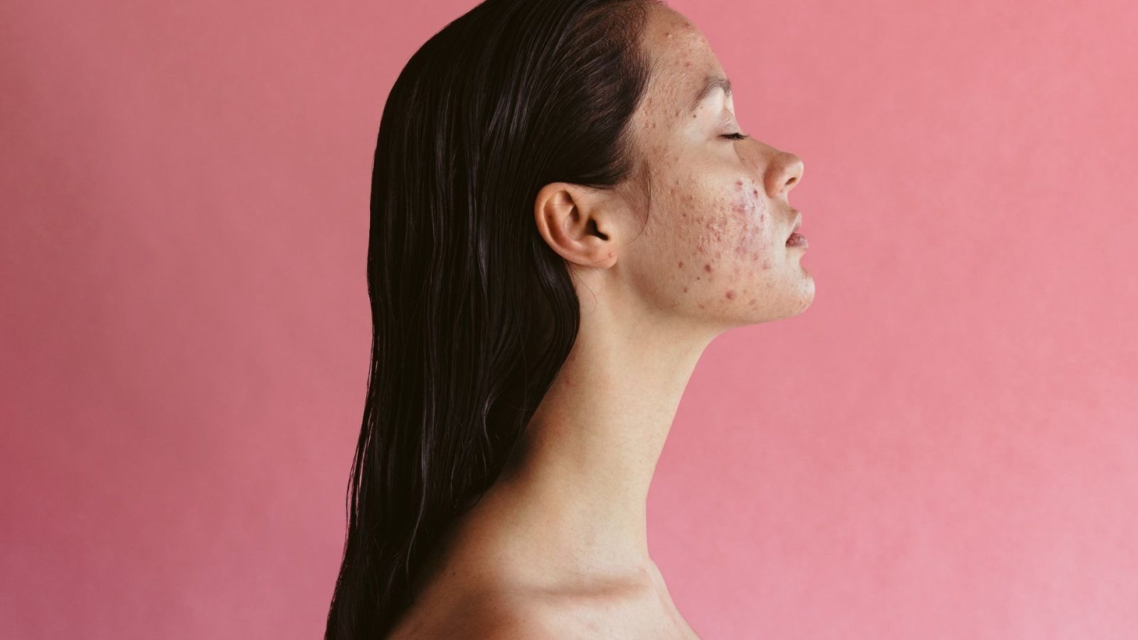 Sunburn for clear skin? Here’s all about the latest acne treatment trend