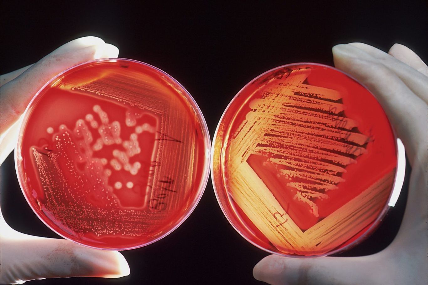 What is mycoplasma infection: Causes and symptoms