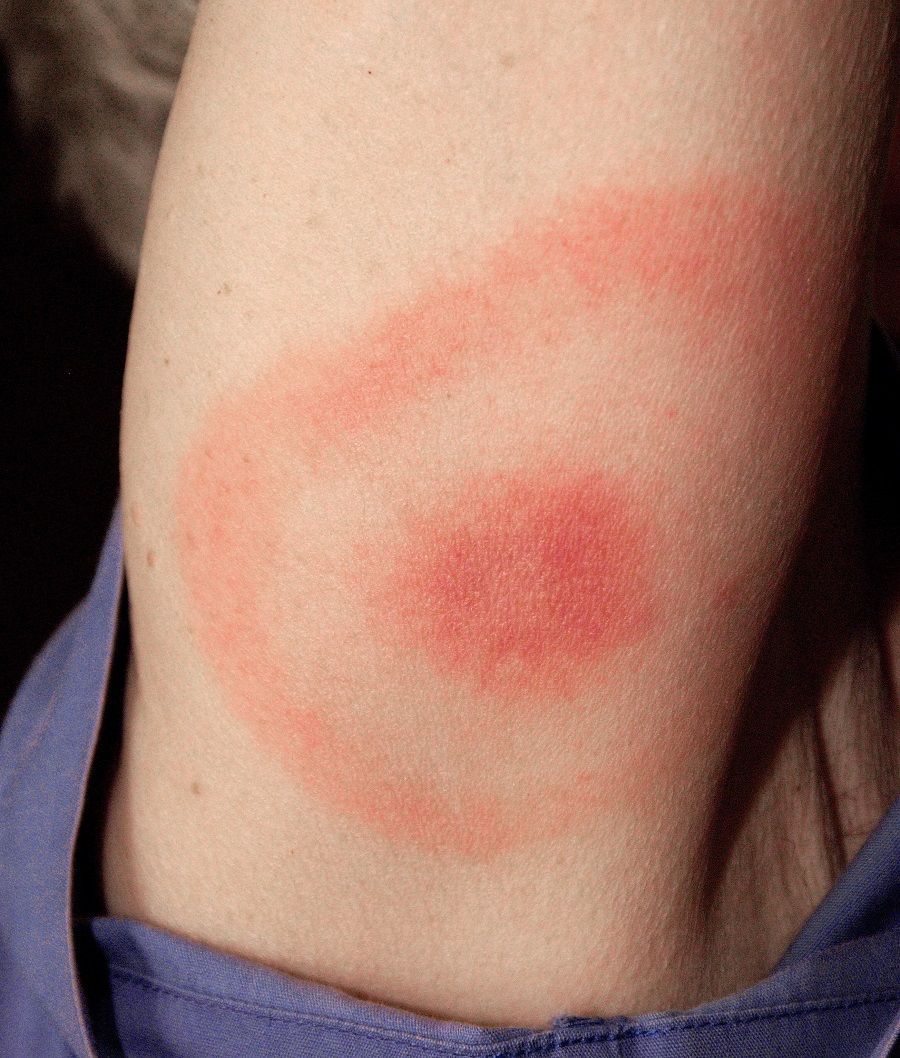 What is Lyme disease