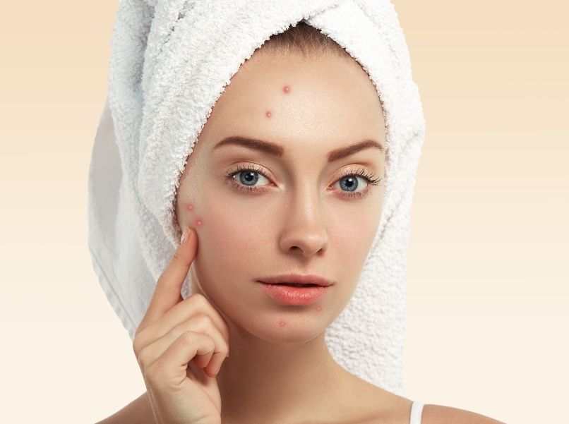Here’s why benzoyl peroxide is great for seasonal acne (plus, the best buys)