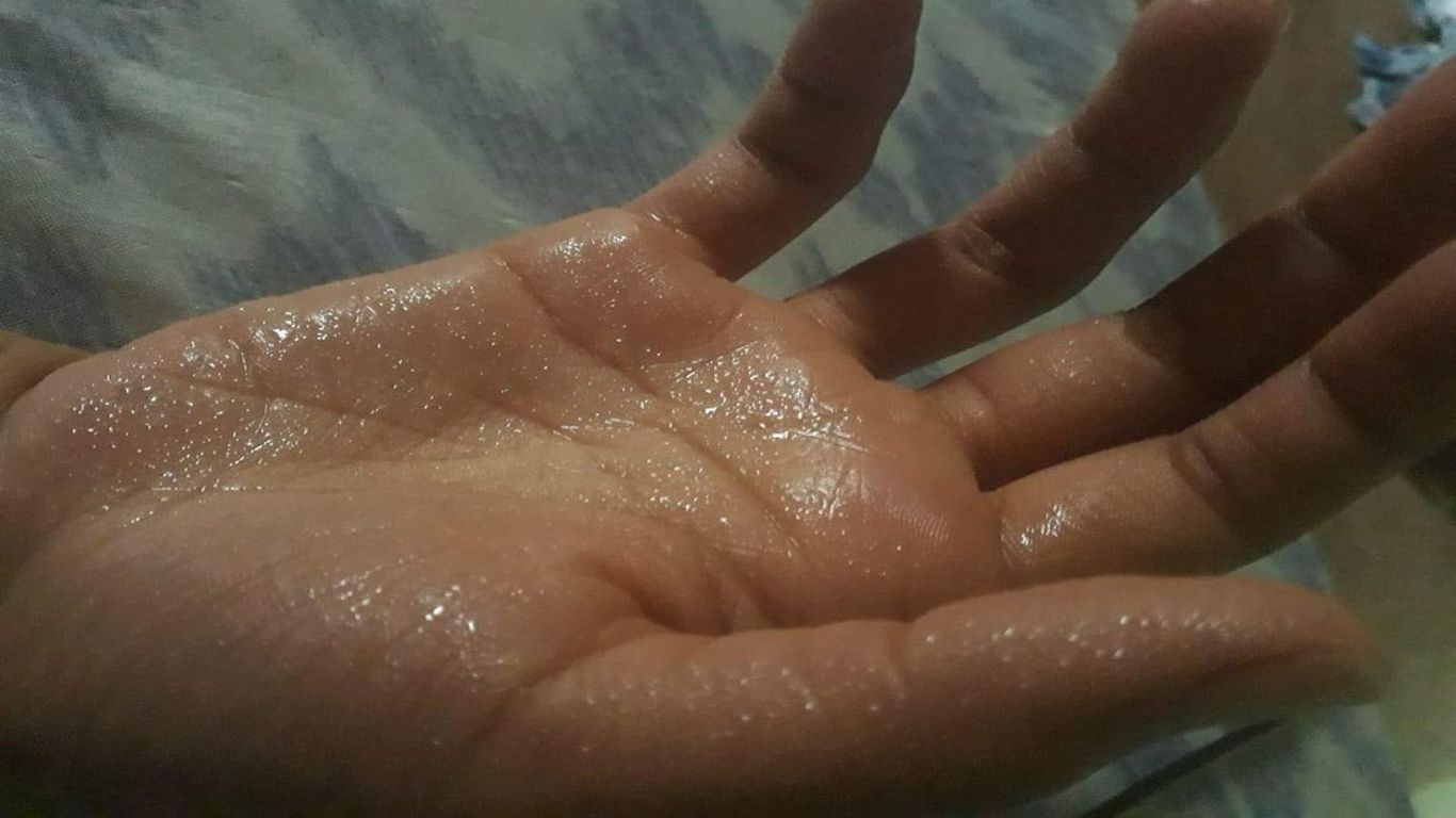 Hyperhidrosis: The various causes of excessive sweating