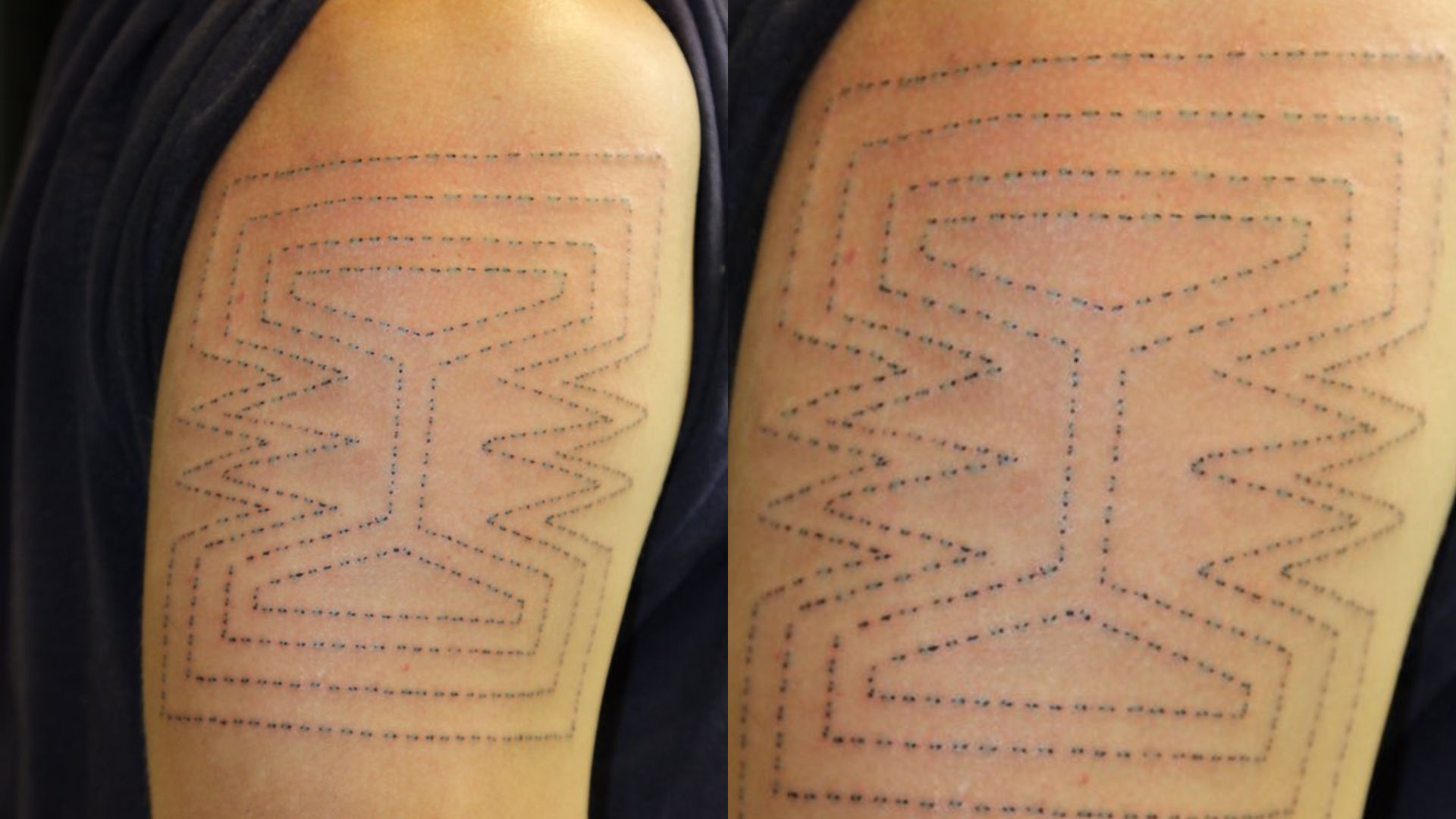 The resurgence of the ancient art of skinstitch tattoos