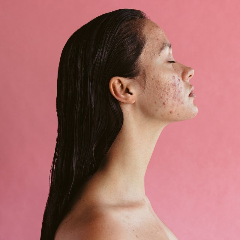 Sunburn for clear skin? Here’s all about the latest acne treatment trend
