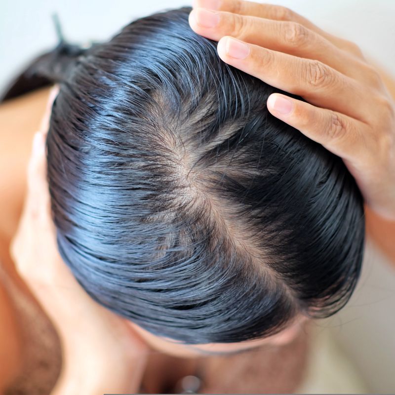 How to get rid of oily hair in winters: Effective tips and remedies